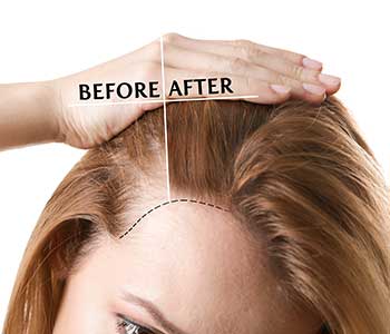 PRP for Hair Loss - Dermatologist in Glendora, CA | Foothill Cosmetic  Surgery Center